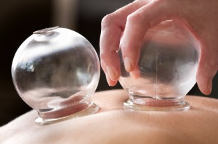 Chinese Cupping